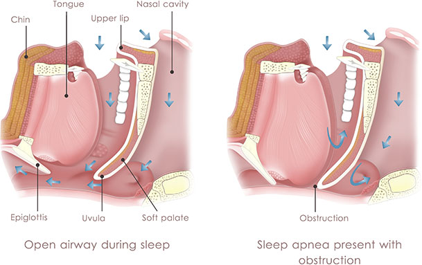 edu-sleep-apnea